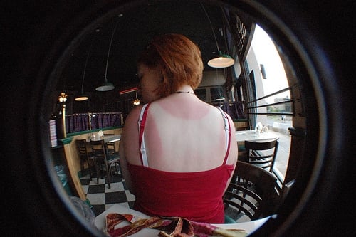 sunburn